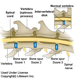Spondylosis Deformans in Dogs